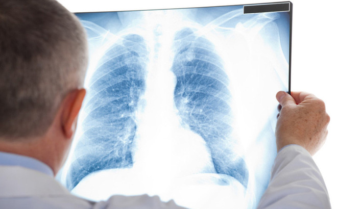 Chụp X-quang ngực chẩn đoán bệnh gì? và hướng dẫn đọc kết quả